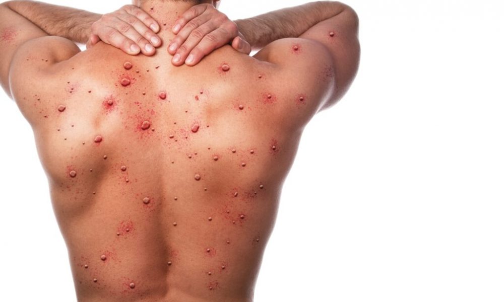 Türk bilim insanları Maymun Çiçeği için PCR Tanı Kiti geliştirdi!