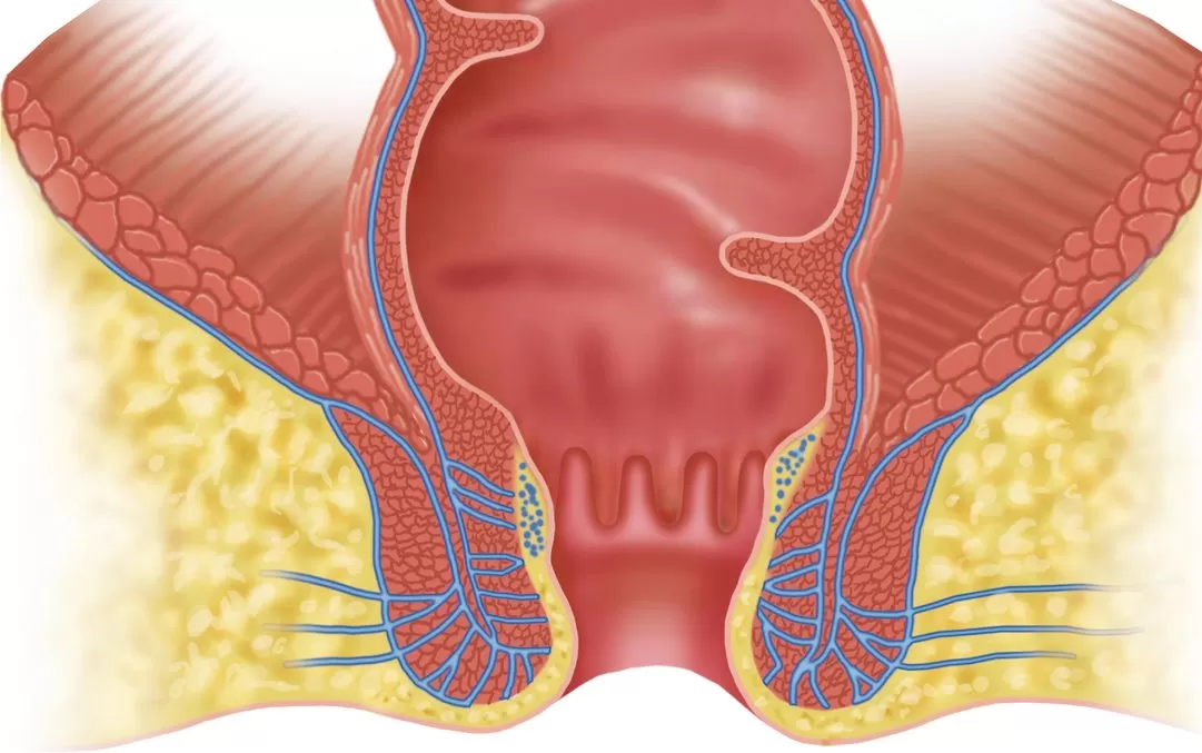 Anal Fistül Tedavisi Mümkün mü?
