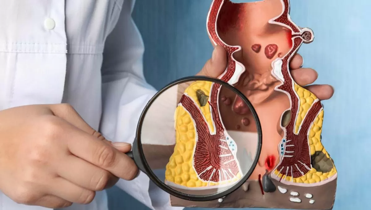 Lazerle Hemoroid Tedavisi ve İyileşme Süreci